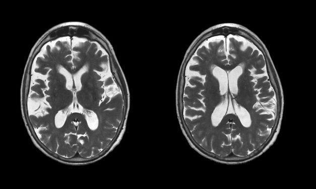 FDA Approves, Leqembi, New Treatment for Early Alzheimer’s