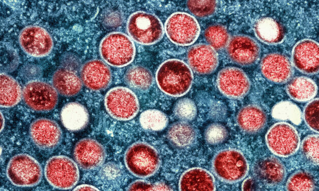 Mpox often causes serious illness, even death, in people with advanced HIV