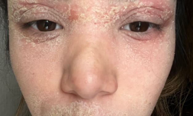 When simple creams turn into suffering