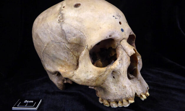 Ancient Skull With Brain Cancer Preserves Clues to Egyptian Medicine