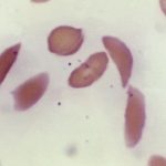 Sickle cell gene therapies offer new hope, accessing them is hard