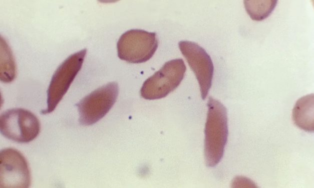 Sickle cell gene therapies offer new hope, accessing them is hard